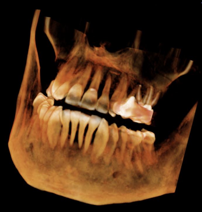 Dental Implants Palm Desert California